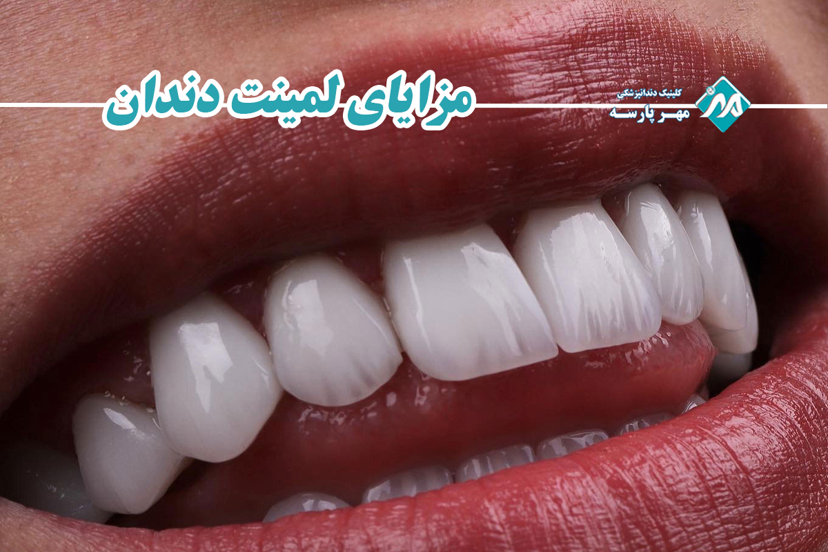 مزایای لمینت دندان