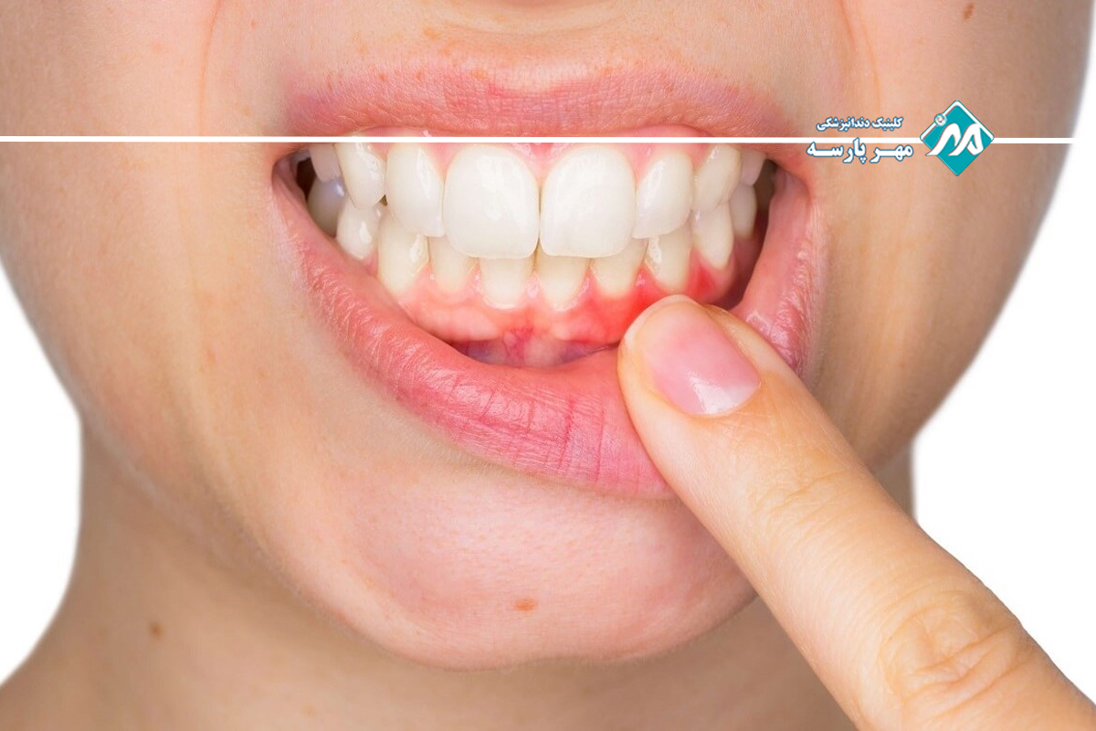 دلایل ایجاد انواع بیماری لثه