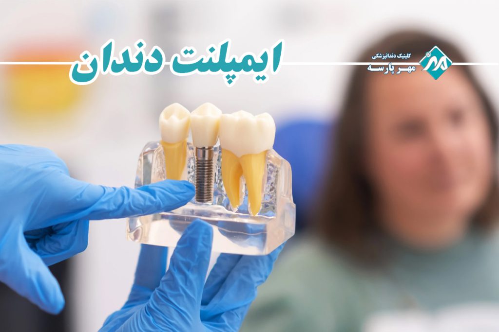 ایمپلنت دندان