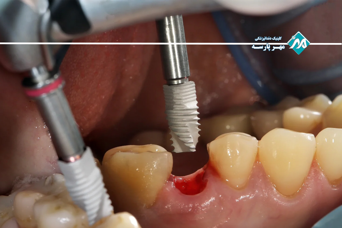 مزایای انجام کاشت ایمپلنت دندان