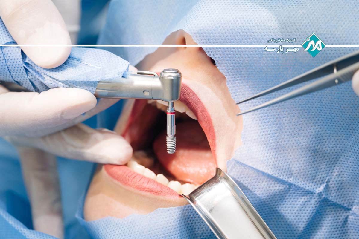 مراحل انجام ایمپلنت دندان