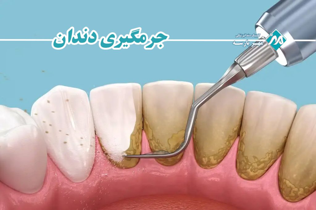 جرمگیری دندان