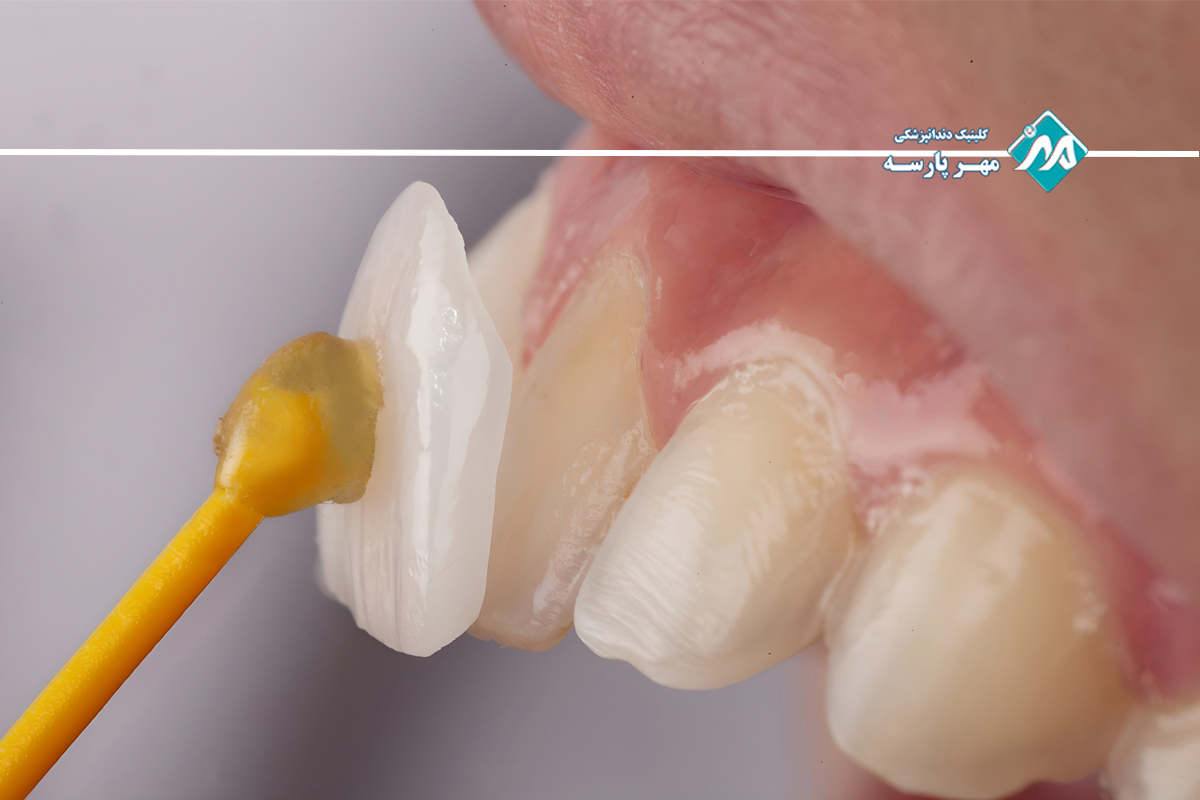 نحوه انجام لمینت دندان