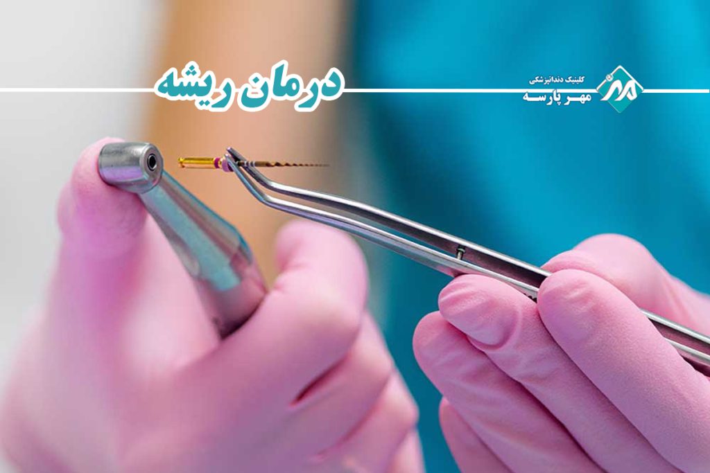 درمان ریشه