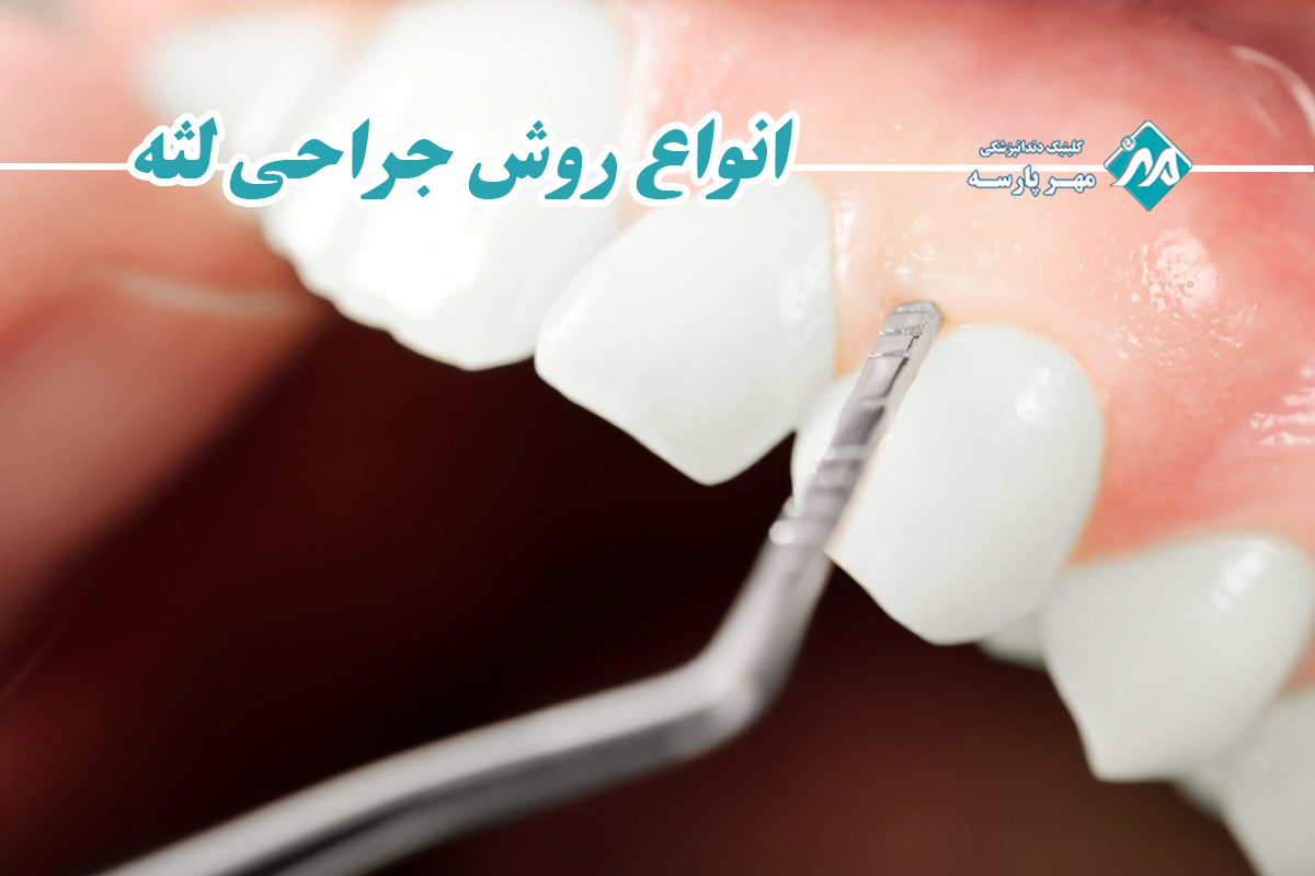 انواع روش جراحی لثه