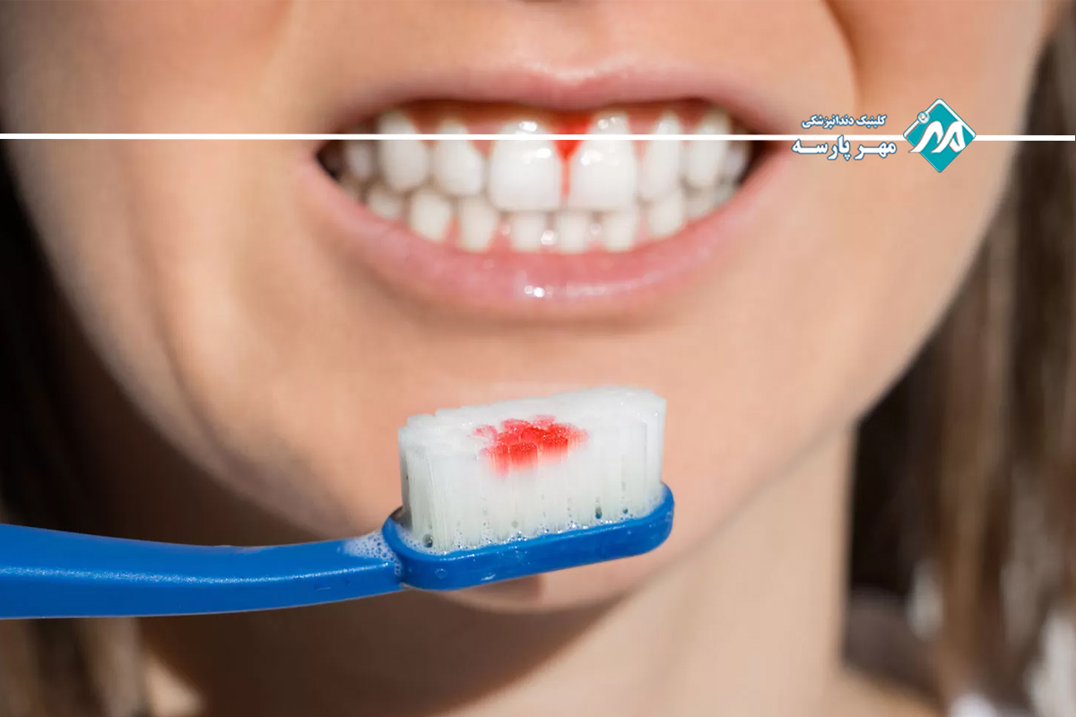 خونریزی لثه