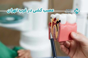 عصب کشی در غرب تهران