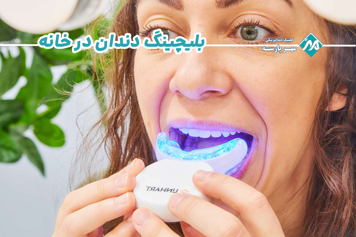 بعد از بلیچینگ دندان در خانه