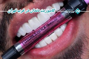 کامپوزیت دندان در غرب تهران