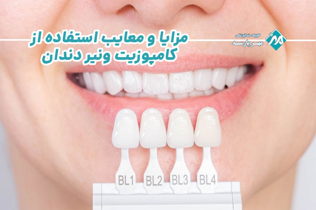 کامپوزیت ونیر دندان