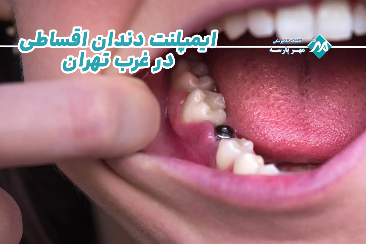 ایمپلنت دندان اقساطی در غرب تهران 