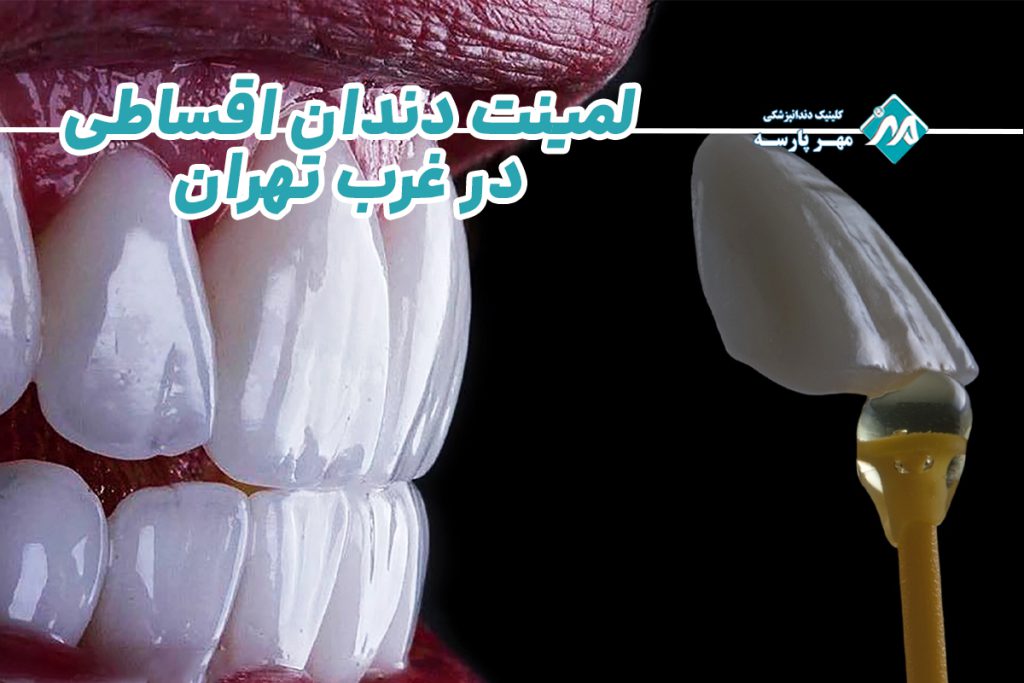 لمینت دندان اقساطی در غرب تهران