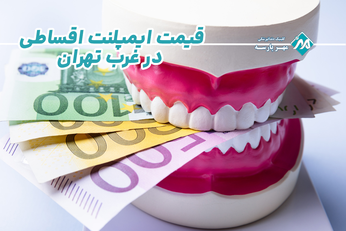 قیمت ایمپلنت اقساطی در غرب تهران