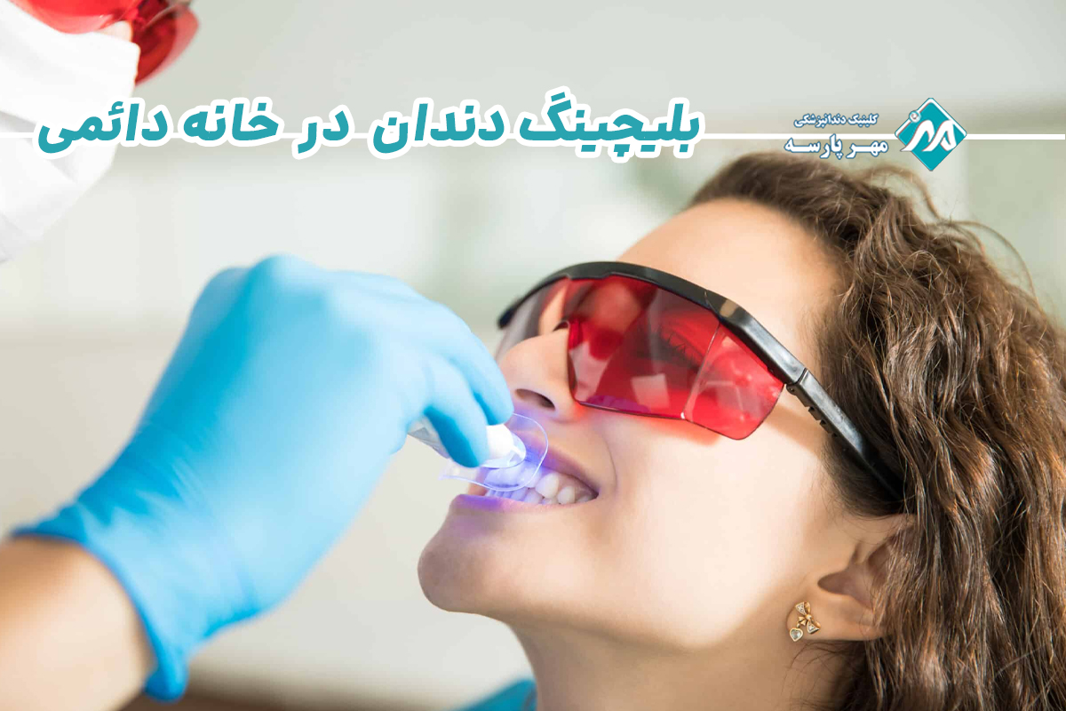 بلیچینگ دندان در خانه دائمی