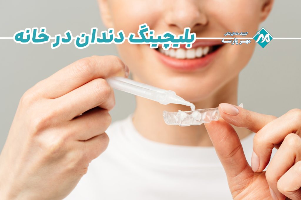 بلیچینگ دندان در خانه