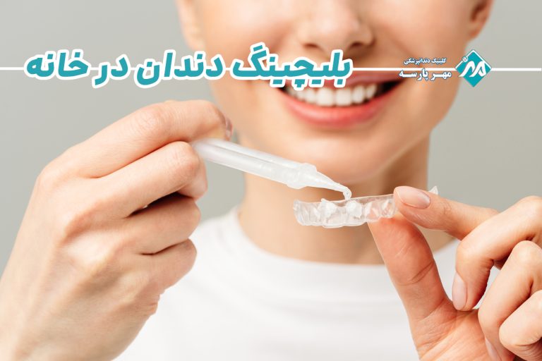 بلیچینگ دندان در خانه