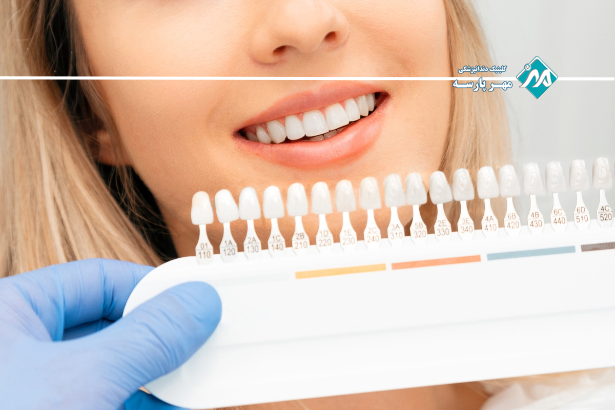 انواع لمینت دندان اقساطی در غرب تهران 