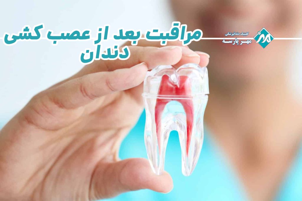 مراقبت بعد از عصب کشی دندان