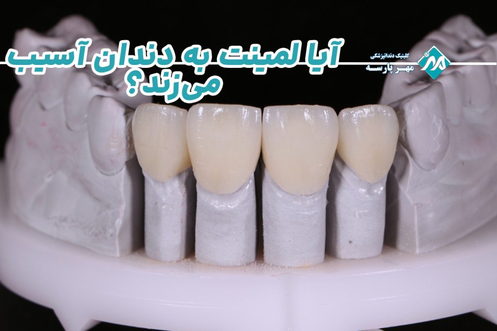 عوارض لمینت دندان