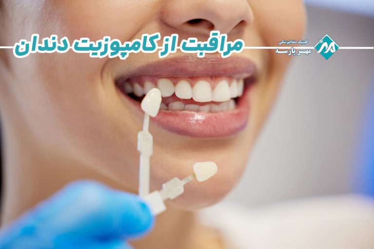 مراقبت از کامپوزیت دندان
