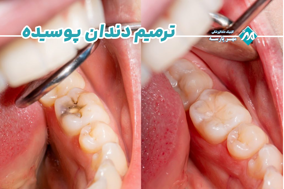ترمیم دندان پوسیده