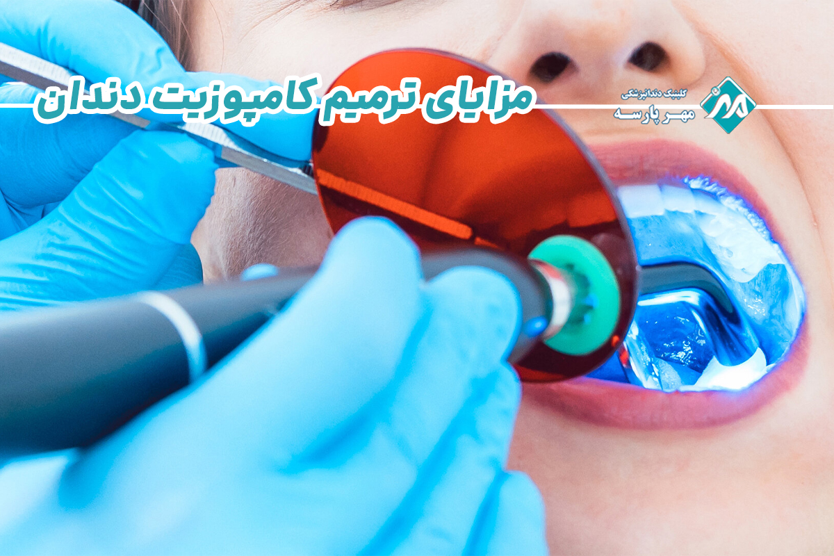 مزایای ترمیم کامپوزیت دندان