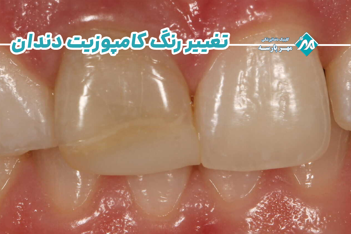 تغییر رنگ کامپوزیت دندان