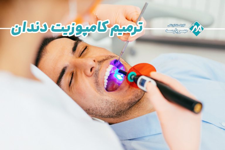 ترمیم کامپوزیت دندان