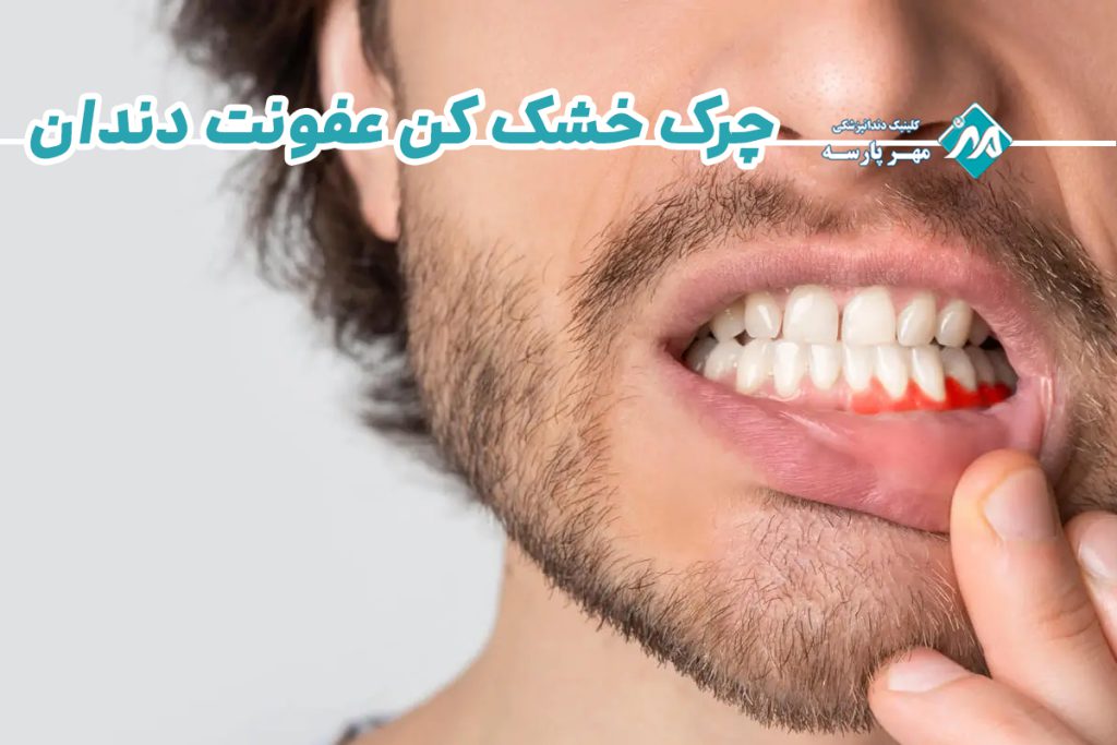 چرک خشک کن عفونت دندان