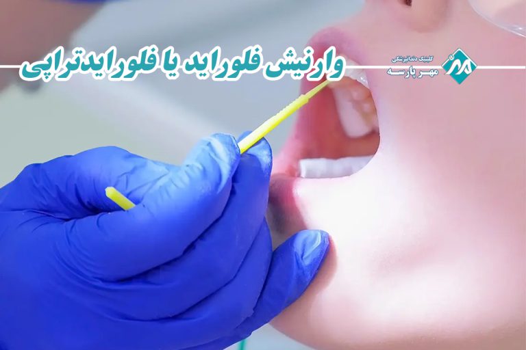 وارنیش فلوراید یا فلورایدتراپی