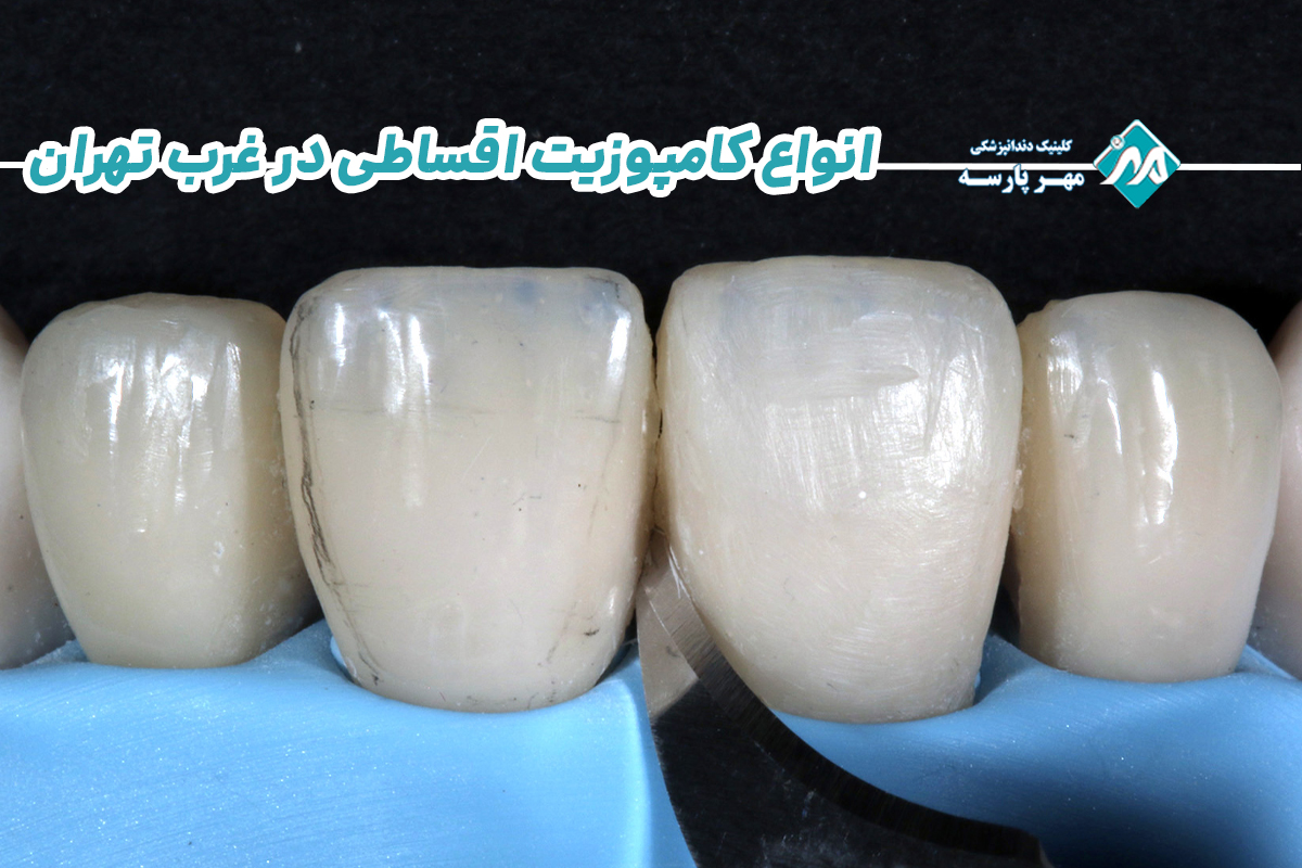 انواع کامپوزیت اقساطی در غرب تهران 