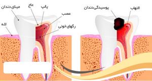 فرق درمان ریشه دندان با عصب کشی