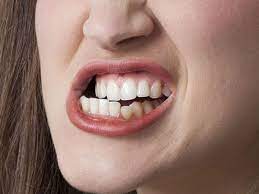 علت شایع تر بودن دندان قروچه