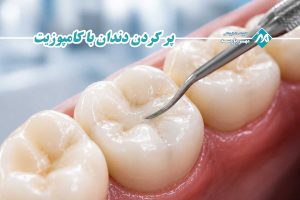 پر کردن دندان با کامپوزیت