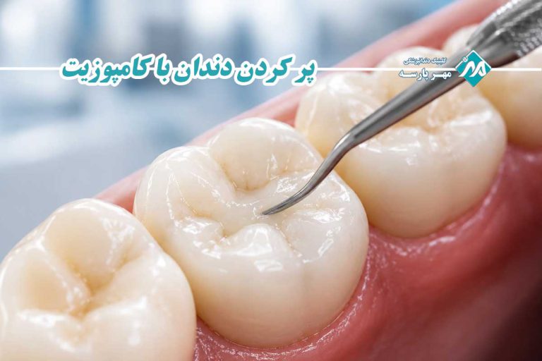 پر کردن دندان با کامپوزیت