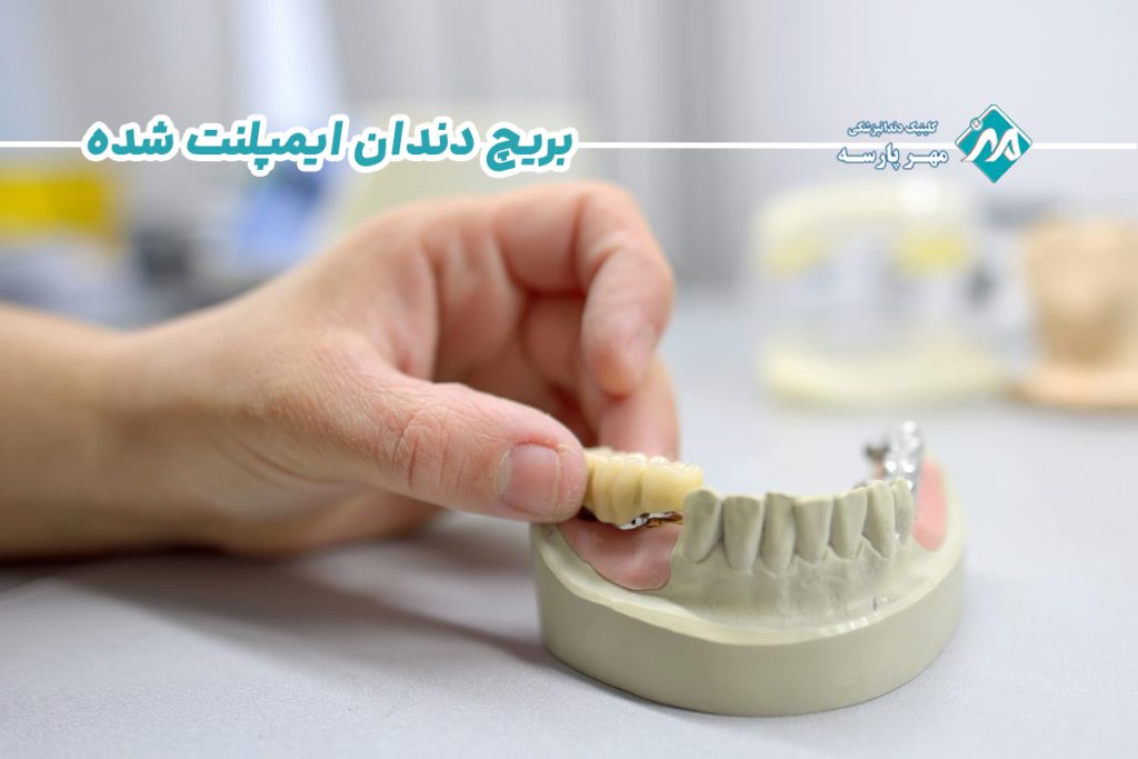 بریج دندان