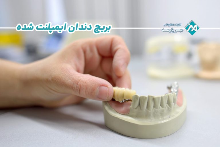 بریج دندان