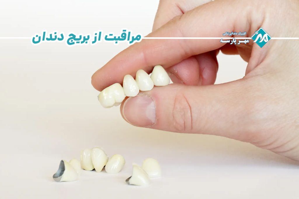 مراقبت از بریج دندان