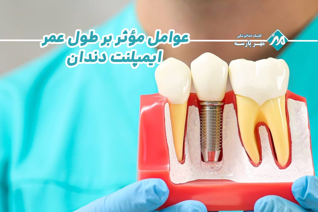 طول عمر ایمپلنت دندان