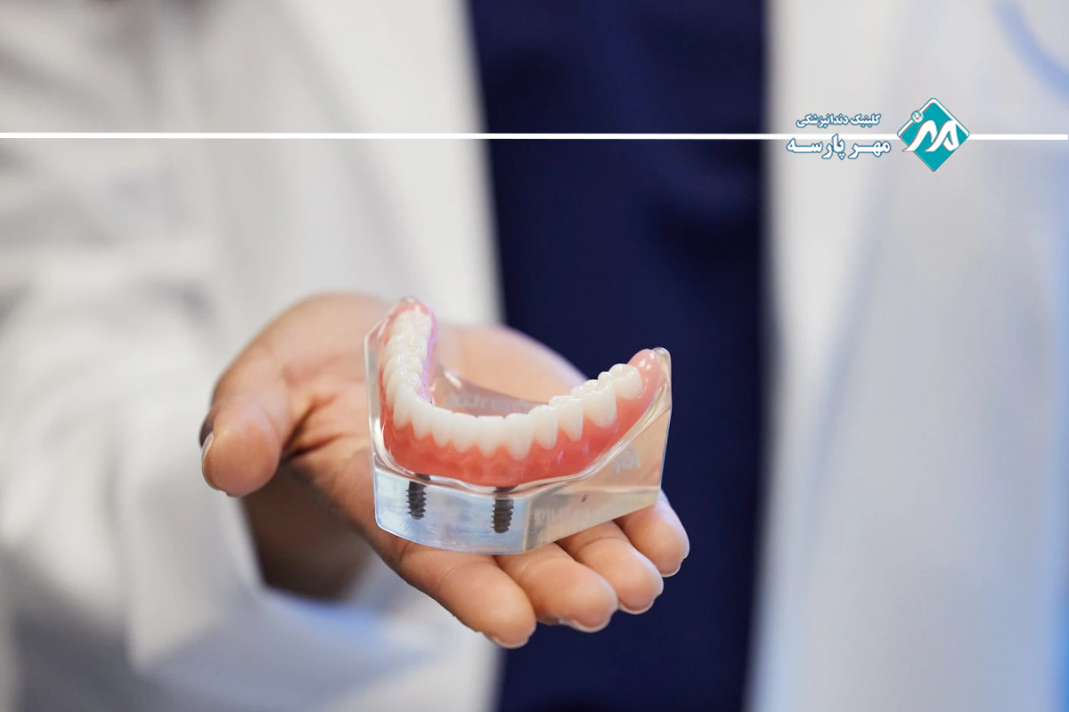 ایمپلنت دندان