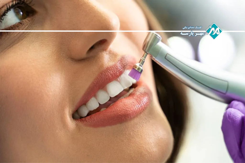 روشهای مختلف جرم گیری دندان