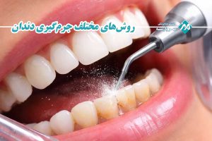 روشهای مختلف جرمگیری دندان