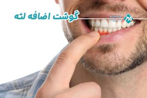 گوشت اضافه لثه