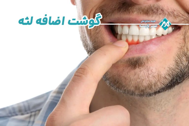 گوشت اضافه لثه