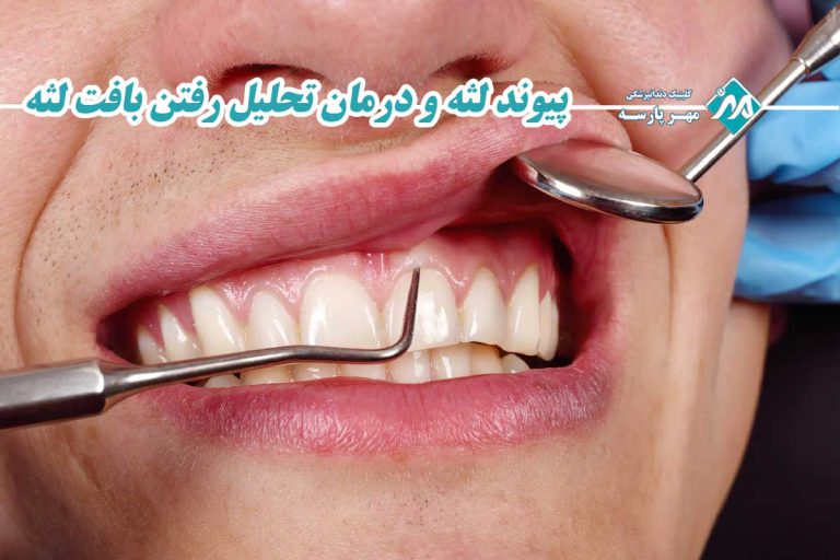 پیوند لثه