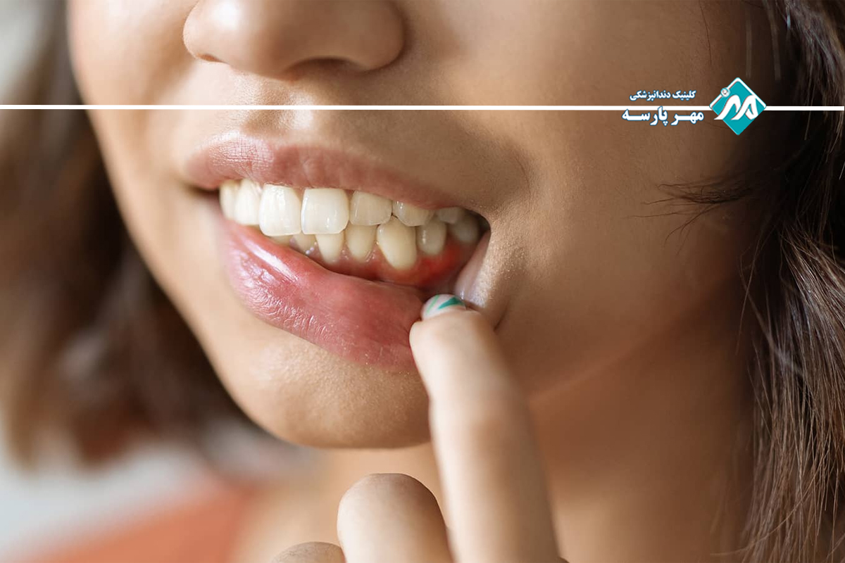 عوارض جراحی لثه ملتهب 