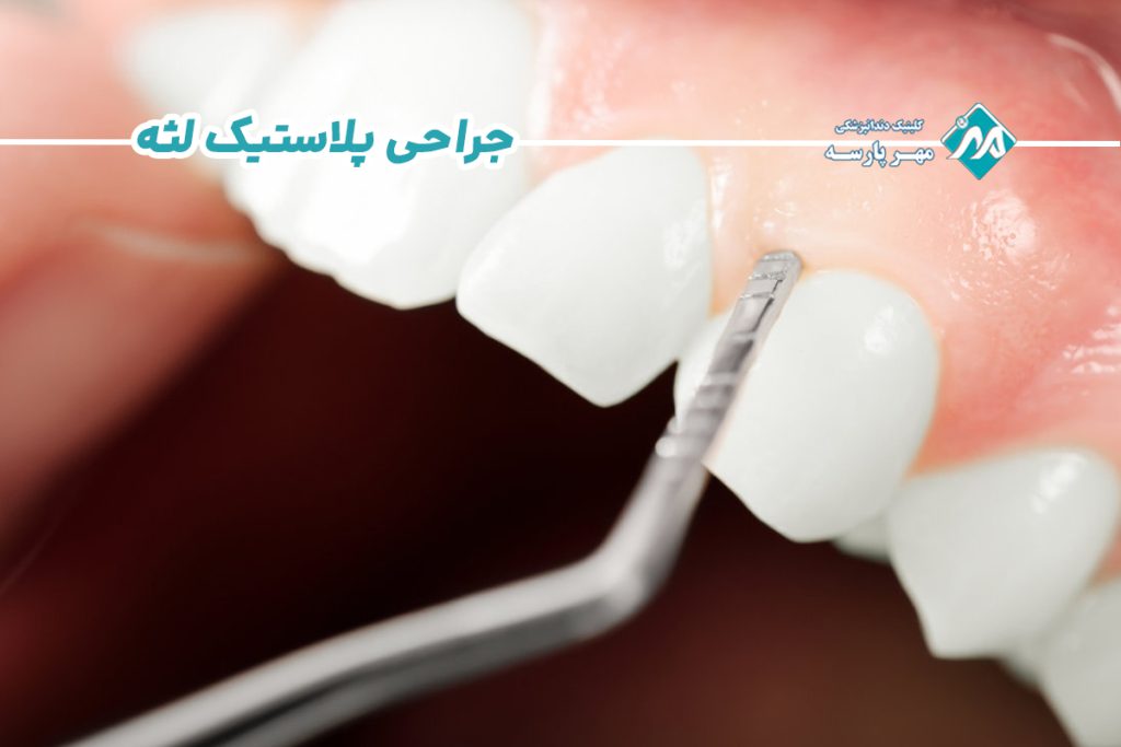 جراحی پلاستیک لثه