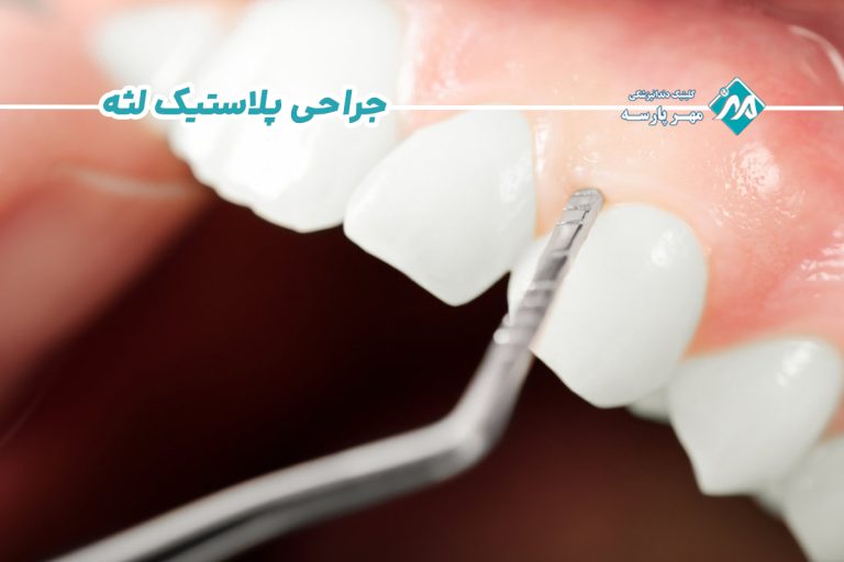 جراحی پلاستیک لثه