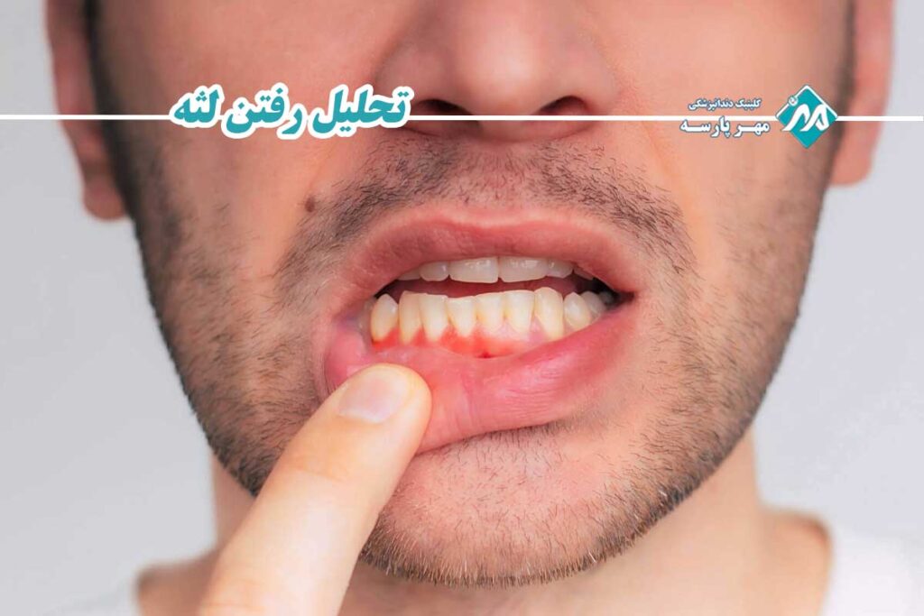 تحلیل رفتن لثه