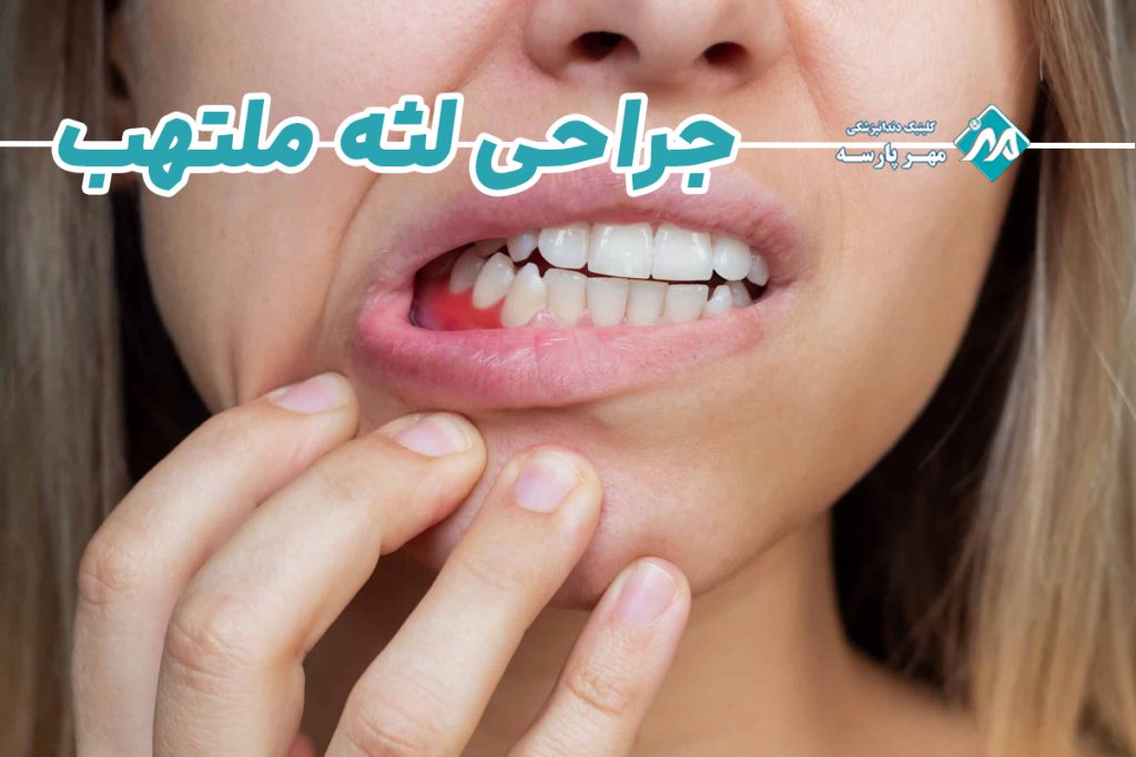 جراحی لثه ملتهب